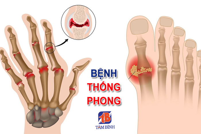 Bệnh thống phong là tên gọi khác của bệnh gút