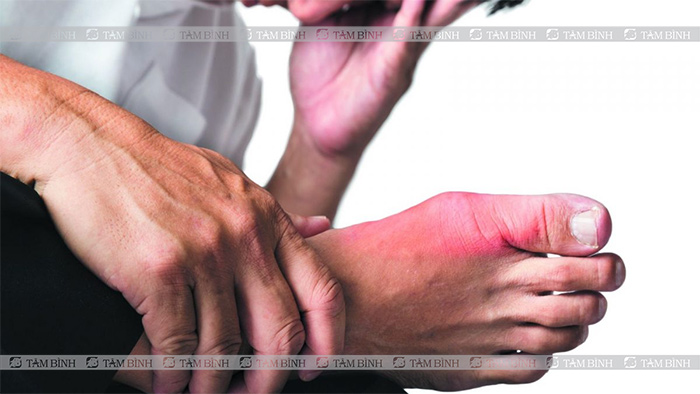 Cơn đau xuất hiện đột ngột vào ban đêm thường ở khớp ngón chân cái