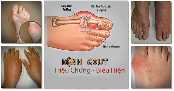 Triệu chứng bệnh gút hay còn gọi là bệnh thống phong
