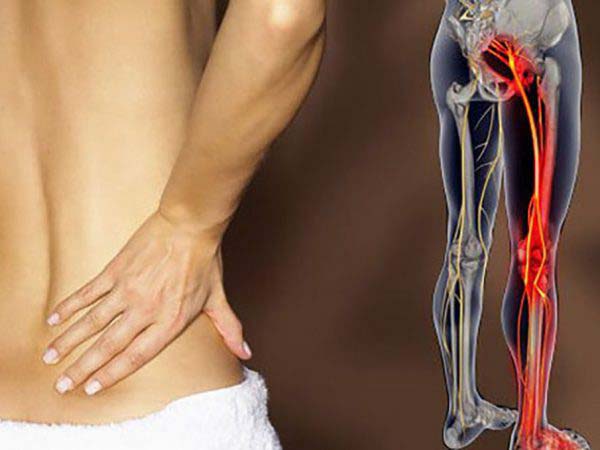 Nguyên nhân đau thần kinh tọa Đau thần kinh tọa do nhiều nguyên nhân gây ra