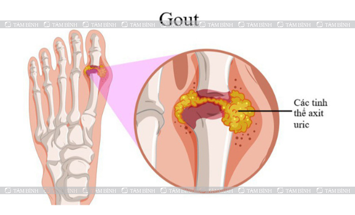 mối liên hệ của Purin với bệnh gout
