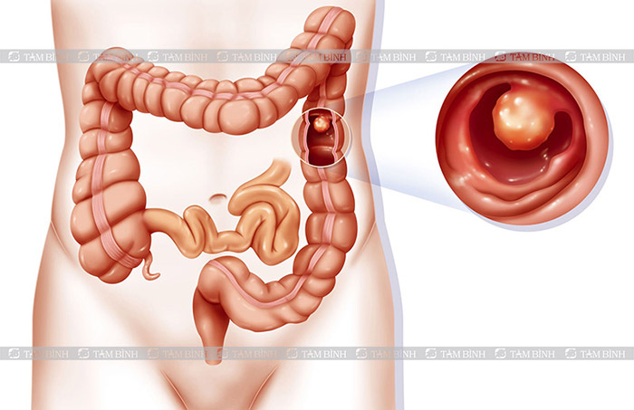 polyp đại tràng gây đau bụng từng cơn