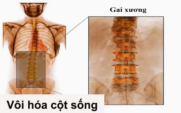 Vôi hóa cột sống lưng