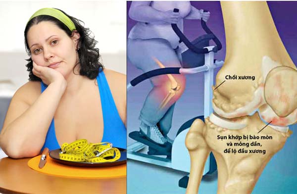 Béo phì làm tăng nguy cơ mắc bệnh xương khớp, trong đó có bệnh gút