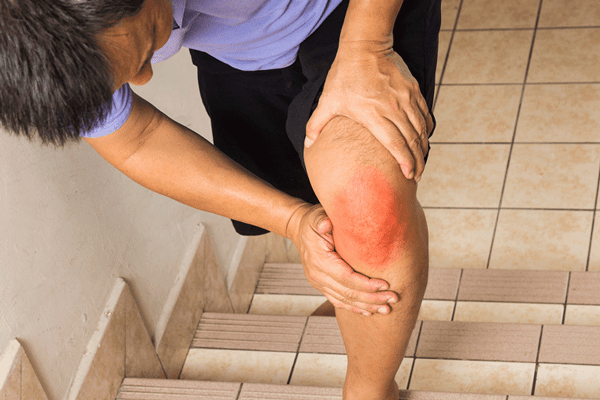 Đau đầu gối khi lên xuống cầu thang không chỉ gây bất tiện trong sinh hoạt mà còn ảnh hưởng đến sức khỏe.