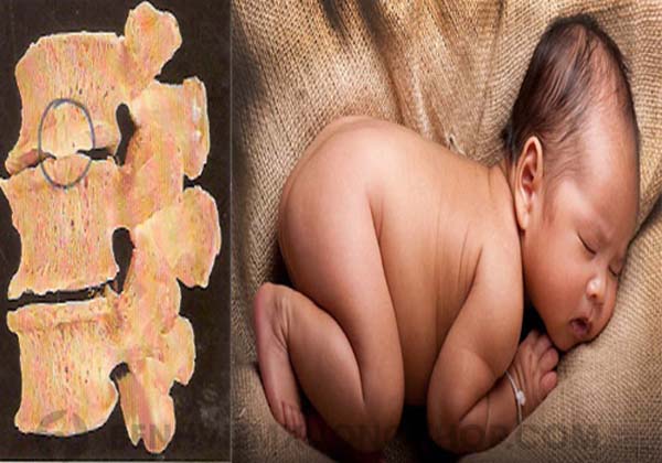Bẩm sinh là nguyên nhân gai đôi cột sống phổ biến nhất.