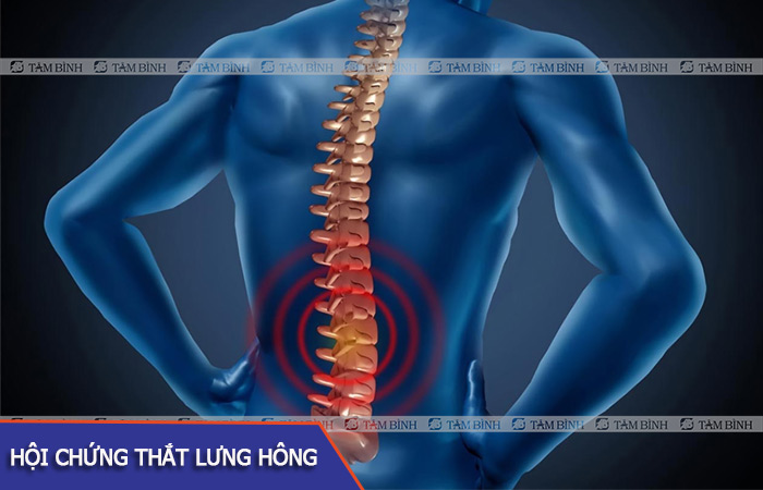 Hội chứng đau thắt lưng hông là bệnh lý liên quan tới các rễ thần kinh