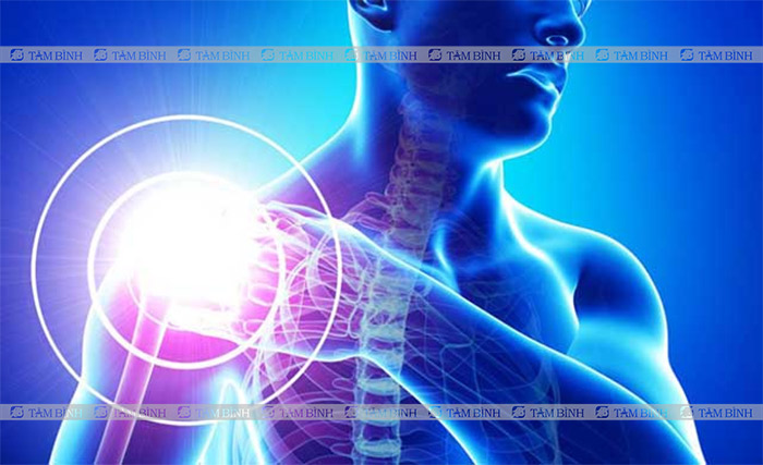  Bệnh xương khớp là nguyên nhân hàng đầu gây đau dây thần kinh cánh tay