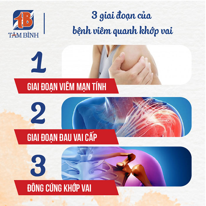 3 giai đoạn của viêm quanh khớp vai