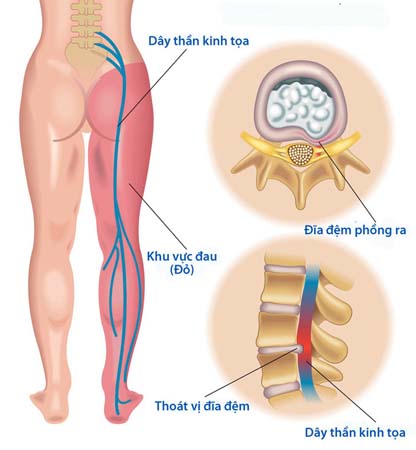 Đau thần kinh tọa hay gặp ở người trung niên