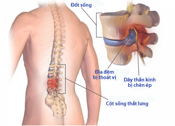 Bệnh thoát vị đĩa đệm