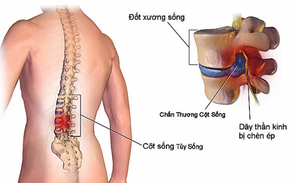 Người bệnh bị chèn dây thần kinh liên sườn xuất hiện những cơn đau dọc theo xương sườn