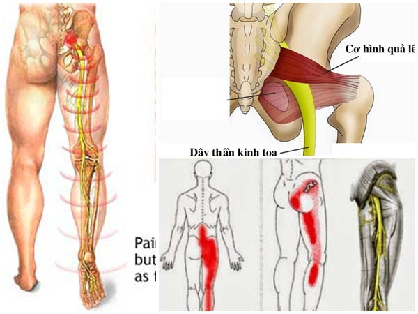 , khi bị đau thần kinh tọa, bạn có thể đi bộ hằng ngày để rèn luyện và hỗ trợ quá trình điều trị bệnh