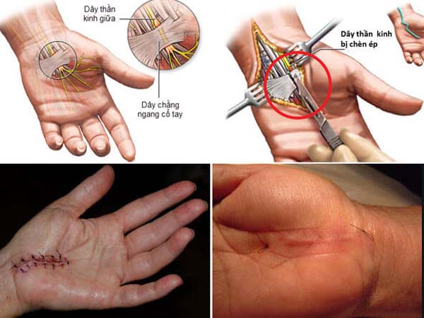 Điều trị hội chứng ống cổ tay bằng phẫu thuật
