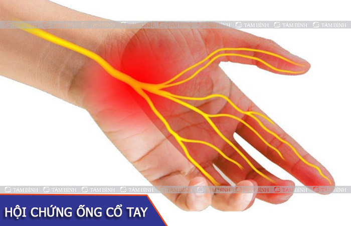 Hội chứng này xảy ra khi dây thần kinh giữa bị chèn ép gây tê bì, đau nhức cổ tay