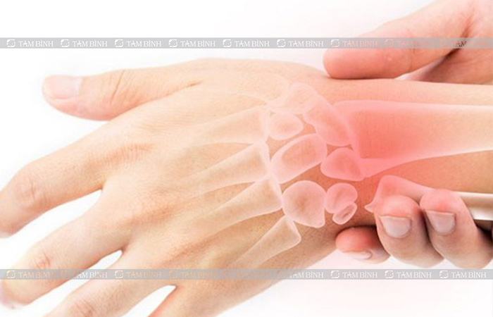 Chấn thương là một trong những nguyên nhân gây nên hội chứng đường hầm cổ tay