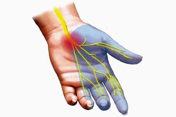Hội chứng ống cổ tay nếu không điều trị kịp thời có thể gây biến chứng nguy hiểm