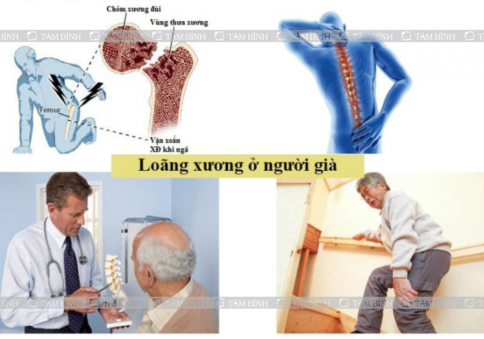 loãng xương ở người cao tuổi