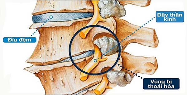 Thoái hóa đốt sống thắt lưng xảy ra ở các đốt: L4 – L5