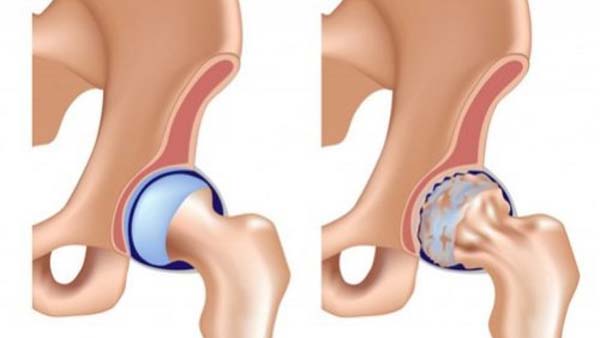 Thoái hóa khớp háng gây ra những cơn đau dai dẳng