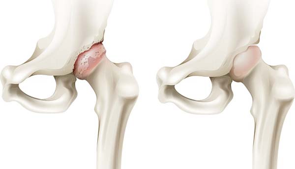 Thoái hóa khớp háng phát triển theo từng giai đoạn cụ thể