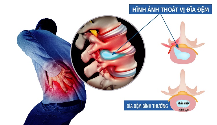 Chẩn đoán