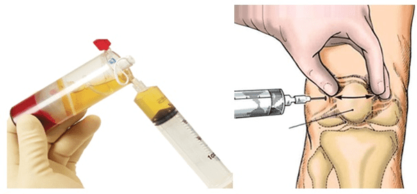 Tiêm chất nhờn acid hyaluronic vào khớp gối là phương pháp mới