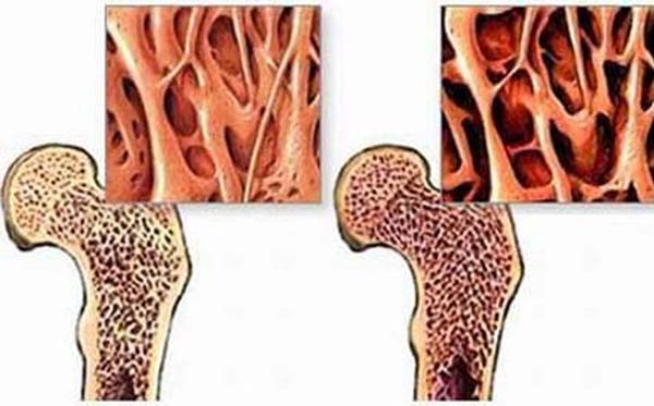 Người bệnh cảm thấy mệt mỏi, chóng mặt, chán ăn, buồn nôn