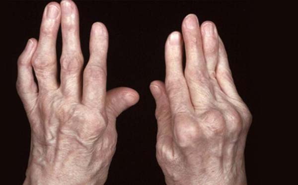 Người bệnh có cảm giác đau các khớp.