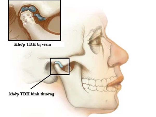 Bệnh gây co thắt và mất cân bằng ở khớp nối giữa xương hàm dưới và xương sọ