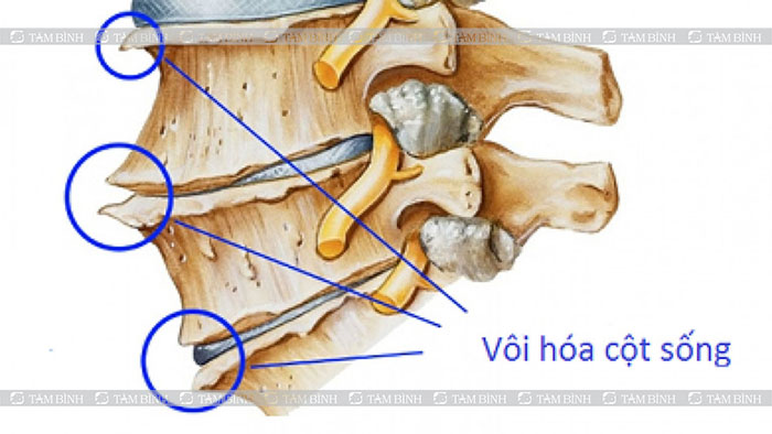 Vôi hóa cột sống cổ