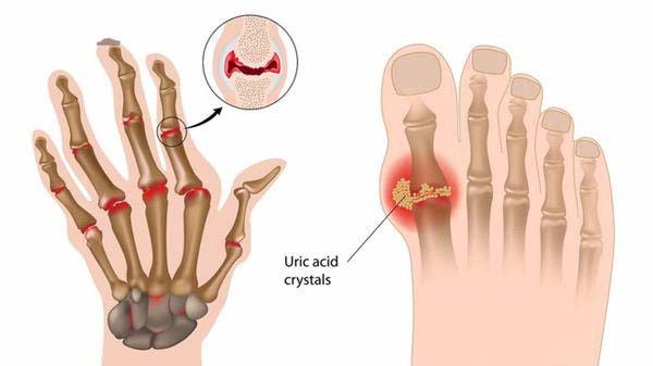 Bệnh gút gây nên những cơn đau tê buốt gây khó chịu cho người bệnh
