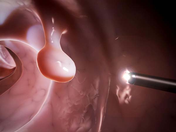 Các khối polyp lớn dần có thể gây biến chứng ung thư đại trực tràng