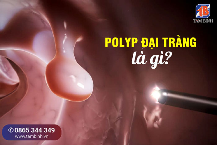 polyp đại tràng là gì