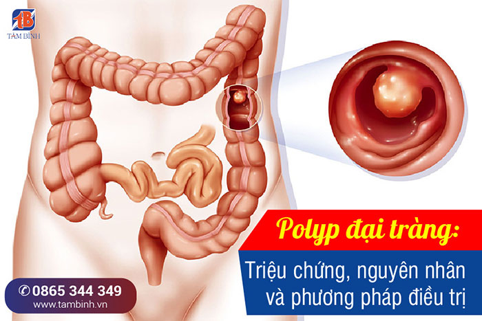 Đau quặn, đau bụng có thể là dấu hiệu của polyp đại tràng không?
