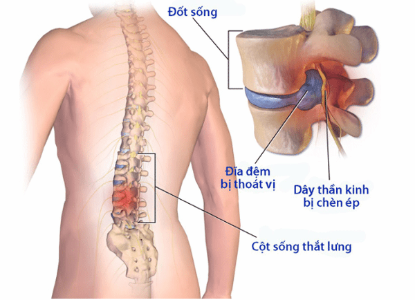 Thoát vị đĩa đệm gây ra những cơn đau đột ngột cho người bệnh