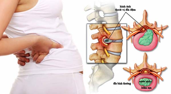 gây ra những cơn đau dữ dội sẽ gây hạn chế, rối loạn vận động cho người bệnh.