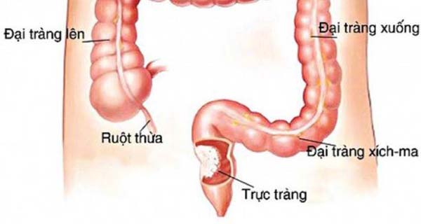 Đại tràng sigma là khu vực dễ bị viêm nhiễm bởi vi khuẩn
