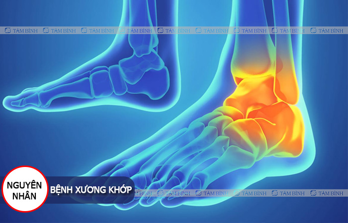 Trọng lượng cơ thể gây ra tình trạng viêm đau khớp cổ chân