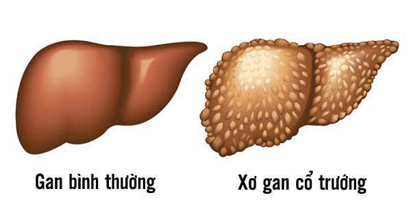 Trị xơ gan cổ chướng bằng bạch truật