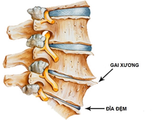 Hình ảnh minh họa bệnh gai xương