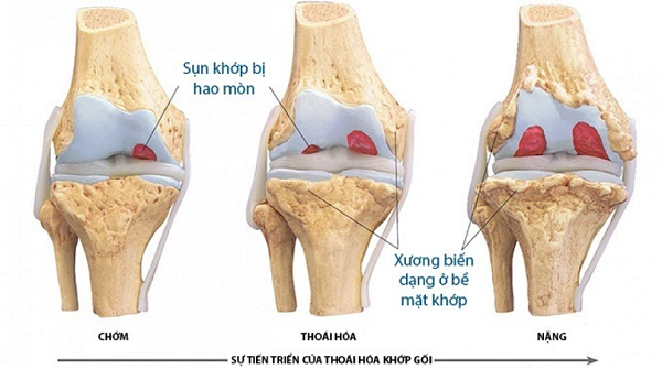 Bệnh thoái hóa khớp gối