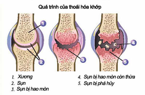 Sự tiến triển của thoái hóa khớp gối