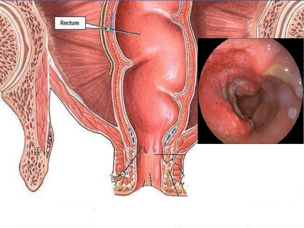 Đau bụng trên rốn do viêm đại tràng