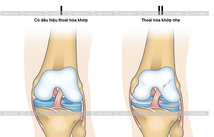 Giai đoạn 1+2 của quá trình thoái hoá khớp gối
