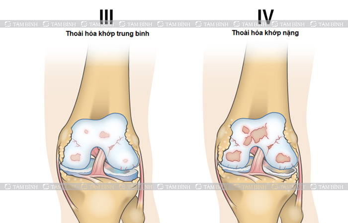 Giai đoạn 3+4: Khớp bị thoái hoá nghiêm trọng