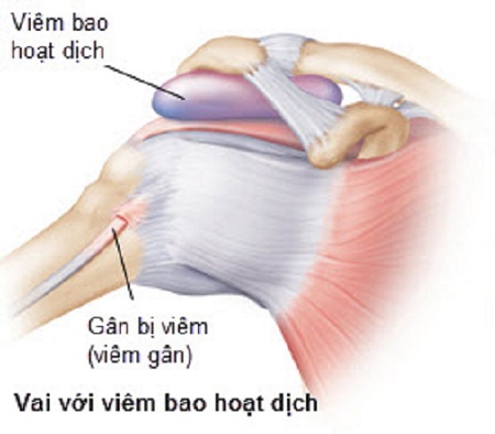 Viêm bao hoạt dịch 1