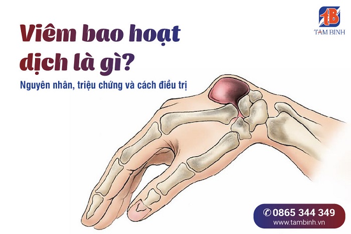 Liệu liệu pháp vật lý có thể giúp điều trị viêm bao hoạt dịch khớp gối không?
