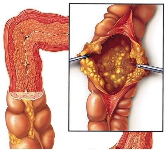 Buồn nên có thể là dấu hiệu của bệnh viêm đại tràng cấp hoặc mạn tính