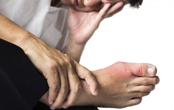 có khoảng 3% người trưởng thành mắc bệnh gút